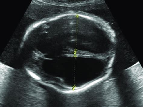Dilated 3rd Ventricle Fetal Ultrasound