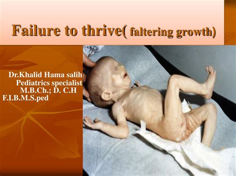 Ppt Failure To Thrive Faltering Growth Powerpoint Presentation