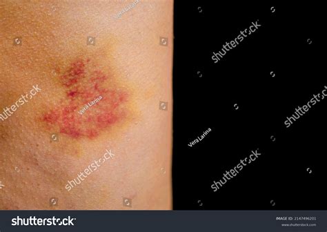 Bruises On Human Body Severe Bruise Stock Photo 2147496201 Shutterstock