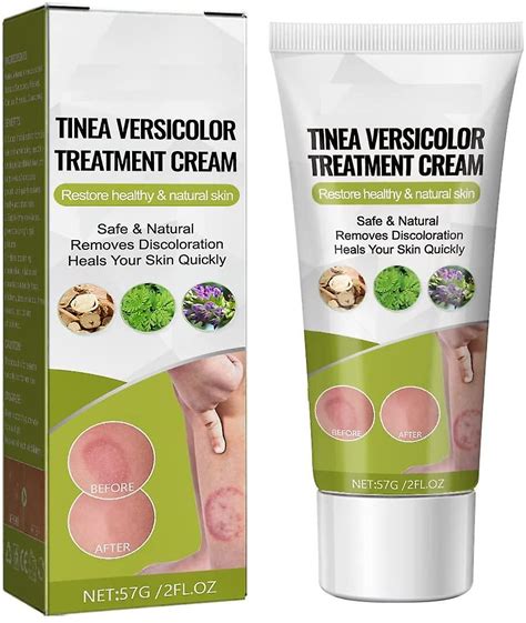 Tinea Versicolor Treatment Antifungal Cream For Tinea Versicolor