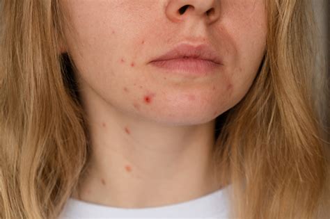 Unrecognizable Woman Showing Her Acne On Face Closeup Acne On Womans