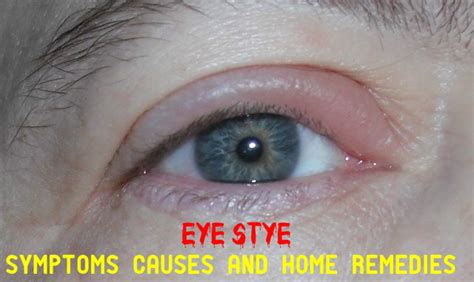 Symptoms Causes And Home Remedies For Eye Stye Stylish Walks