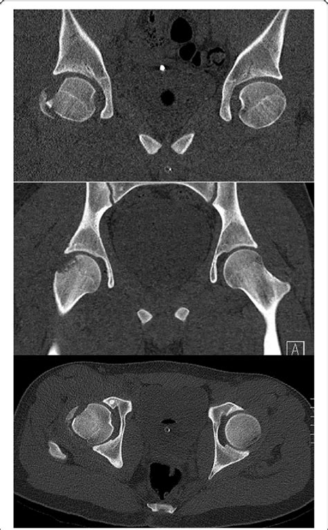 Ct Scan Pictures Showing The Closed Reduction Of The Hip Joint A Type