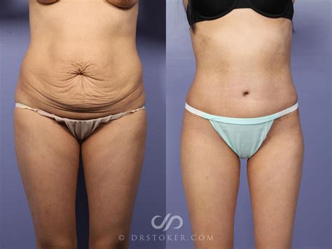 Geheimnisvoll Stadtblume Text abdominoplasty before after Drehen Verrat