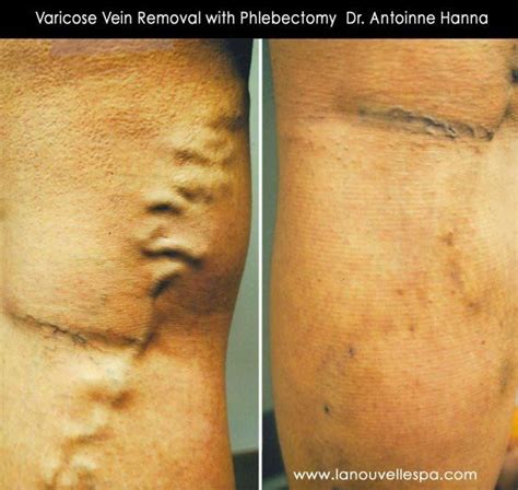 Pin On Varicose Veins Treatment Removal