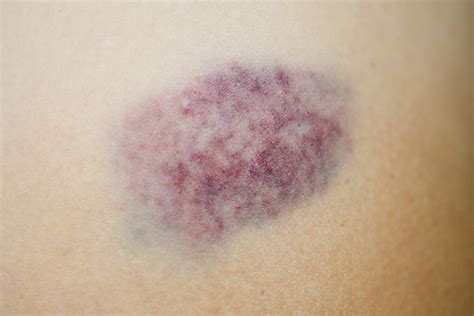 Should You Be Worried About Bruising Easily Wellness Us News