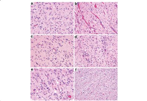 Histologic Features Of Gangliogliomas With Different Genetic