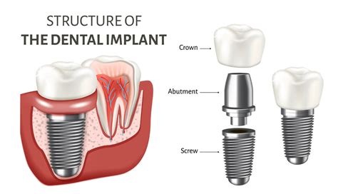 Is A Dental Implant And Crown Right For You Learn Here