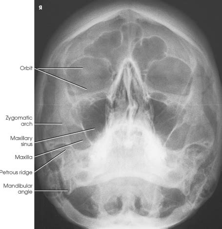 The largest is the patella. FACIAL BONES | Radiology Key