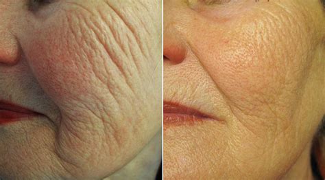 Profound Before And After Gallery Contour Dermatology