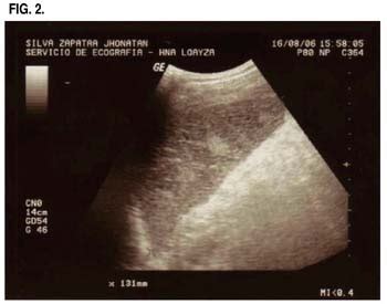 Quando me refiro ao problema de isquemia no coração, digo: Dolor Abdominal Agudo debido a Infarto Esplénico en un ...