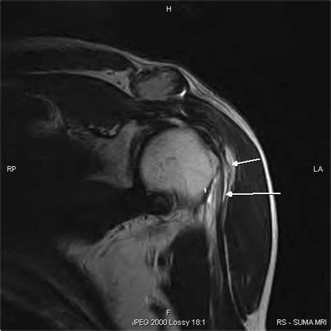 Long Head Of Biceps Rupture Mri Sumer S Radiology Blog