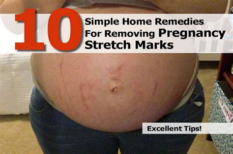10 Simple Home Remedies For Removing Pregnancy Stretch Marks