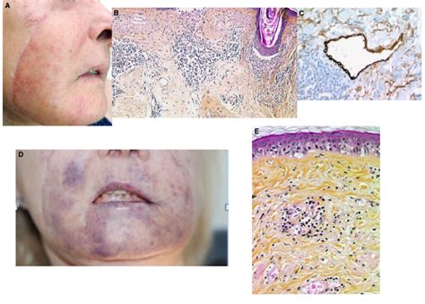 A Maculopapular Lesions November 2014 Of The Facial Graft B