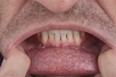 Pictures Of Early Signs Of Tongue Cancer