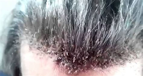 A big invasion of lice - YouTube