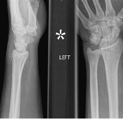 A 2 Mm Displaced Ulnar Styloid Fracture That Is Reduced With Reduction