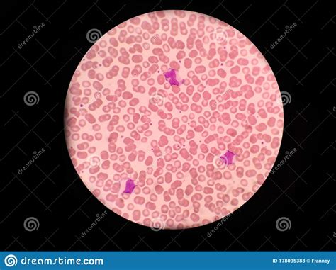 Monocyte And Lymphocyte Red Blood Cell Blood Smear Royalty Free Stock