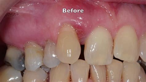 Periodontal Gum Disease Stages
