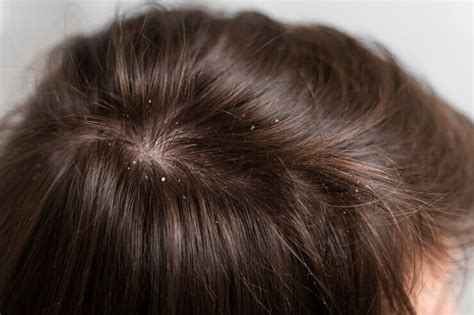 The Ultimate Guide To Understanding Dandruff And Its Causes Best