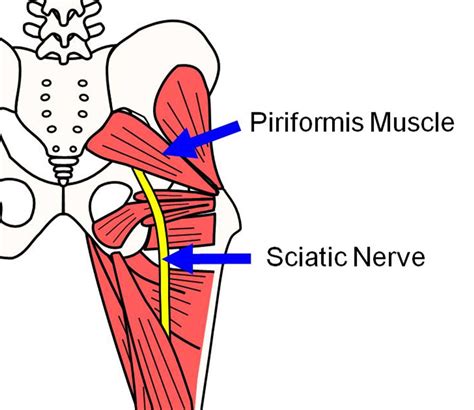 Piriformis Muscle Strain