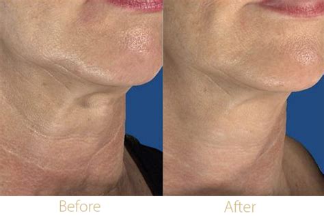 Fractional Rf Microneedling In Riyadh Best Results