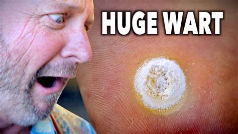 Huge Decaying Wart Frozen With Liquid Nitrogen Dr Paul Youtube