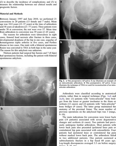 A This Preoperative Ap Pelvic X Ray Illustrates An Example Of An
