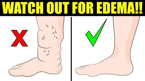 6 Reasons You Have Swollen Feet Youtube