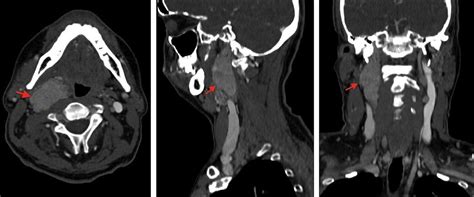 Resection Of A Large Carotid Paraganglioma In Carney Stratakis Syndrome