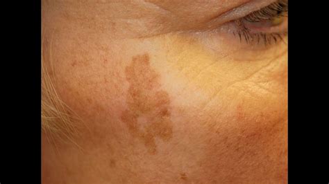 Simple Trick To Remove Age Sun And Brown Spots Sun Spots Removal Age Spot Removal Spot