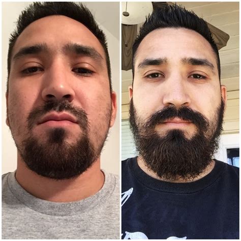 Here are some minoxidil beard before and after results! Patchy Beard success stories Before and After photos ...