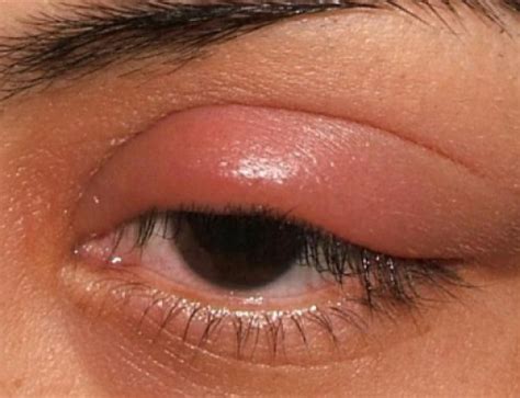 Swelling Under Eye Cheekbone With Pain Redness Causes Treatment