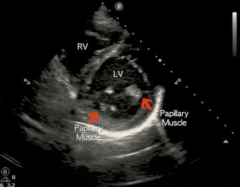 Cardiac Ultrasound Echocardiography Made Easy Step By Step Guide