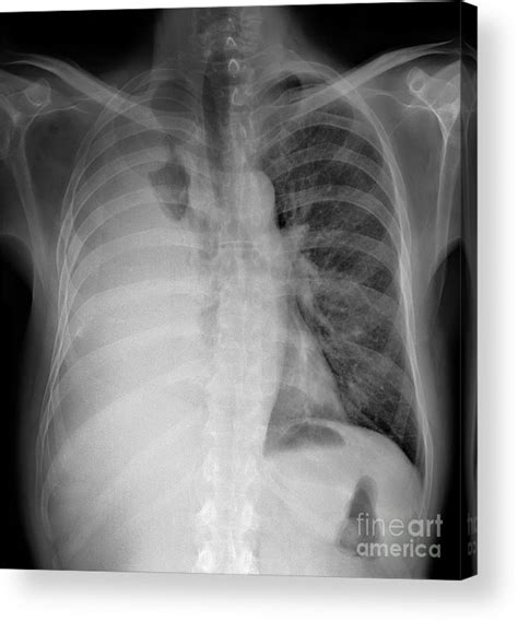 The left lower zone is uniformly white. Pleural Effusion, X-ray Acrylic Print by Science Photo Library