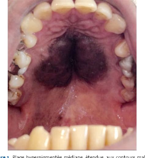 Figure 1 From Kimuras Disease Of The Hard Palate Semantic Scholar