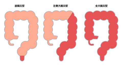 から お砂糖いらないの〜 夜 作っておけば 朝食に出せるから バタバタの朝に良き #潰瘍性大腸炎 #お菓子作り pic.twitter.com/iiv8jnv8z0. 潰瘍性大腸炎の治療法－薬を使った内科的治療から手術による ...