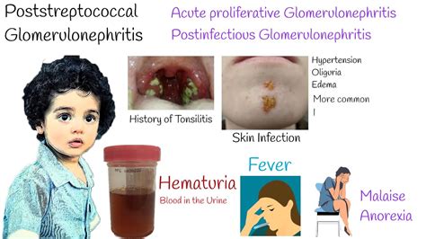 Acute Proliferative Glomerulonephritis Poststreptococcal