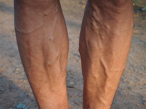 Varicose Veins More Than Just A Cosmetic Issue Medical Channel Asia