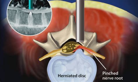 What Is Micro Endoscopic Discectomy Stephen P Courtney Md