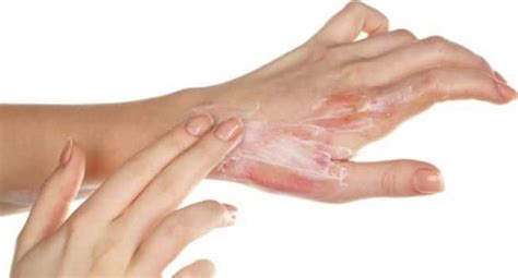 Mistakes To Avoid While Treating Skin Burns