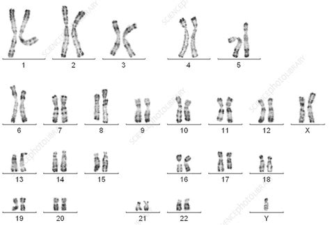 Klinefelters Syndrome Karyotype Male Stock Image C0030955