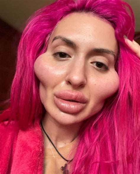 Instagram Model With World S Biggest Cheeks Wants More Surgery