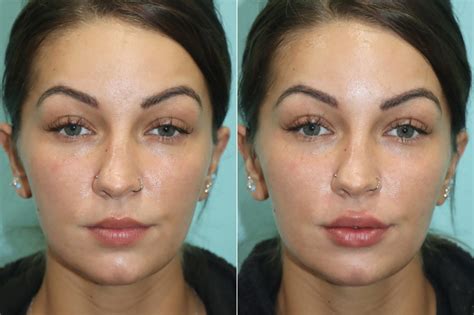 lip injections before and after photos the naderi center for plastic surgery and dermatology