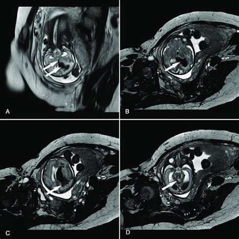 Intrauterine T2 Weighted Magnetic Resonance Images Mri Demonstrating