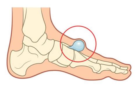 Do You Have A Bump On Top Of The Foot Hard Painful Or Bone Bump