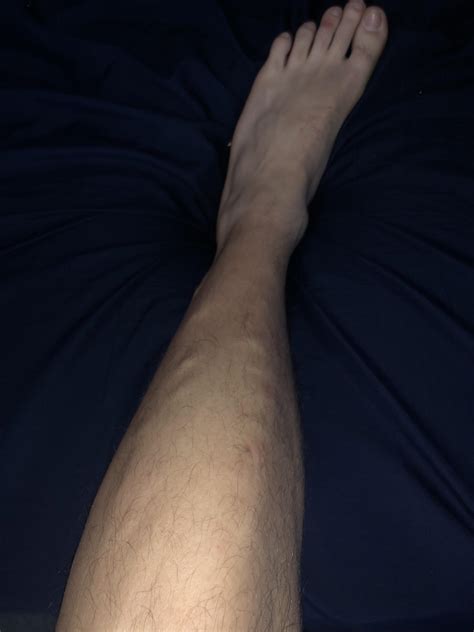 Bumps On My Legs Under Skin Rmedicaladvice