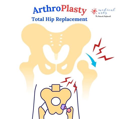 Arthroplasty Total Hip Replacement Surgery Arthrosis And Arthritis