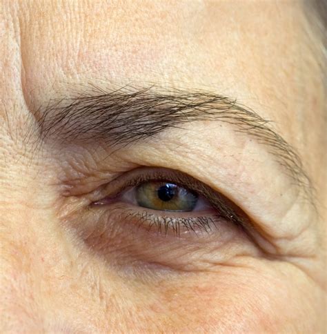 Eyelids And Upper Face Diseases Ophthalmology Bellevue Clinic