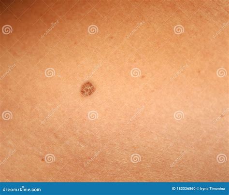 Brown Spots On The Skin Spot Dark Stock Photo Image Of Condition